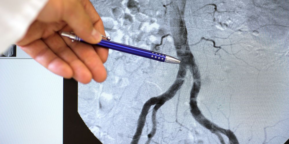 Ein Facharzt für Gefäßchirurgie betrachtet den Befund vor einer Angioplastie.