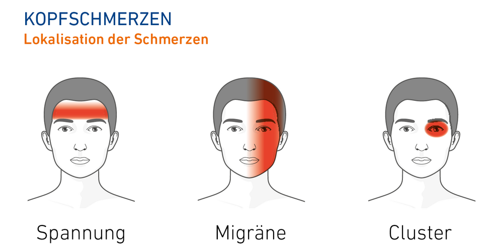 Die Grafik zeigt die Regionen am Kopf, wo die verschiedenen Arten von Kopfschmerzen auftreten können.